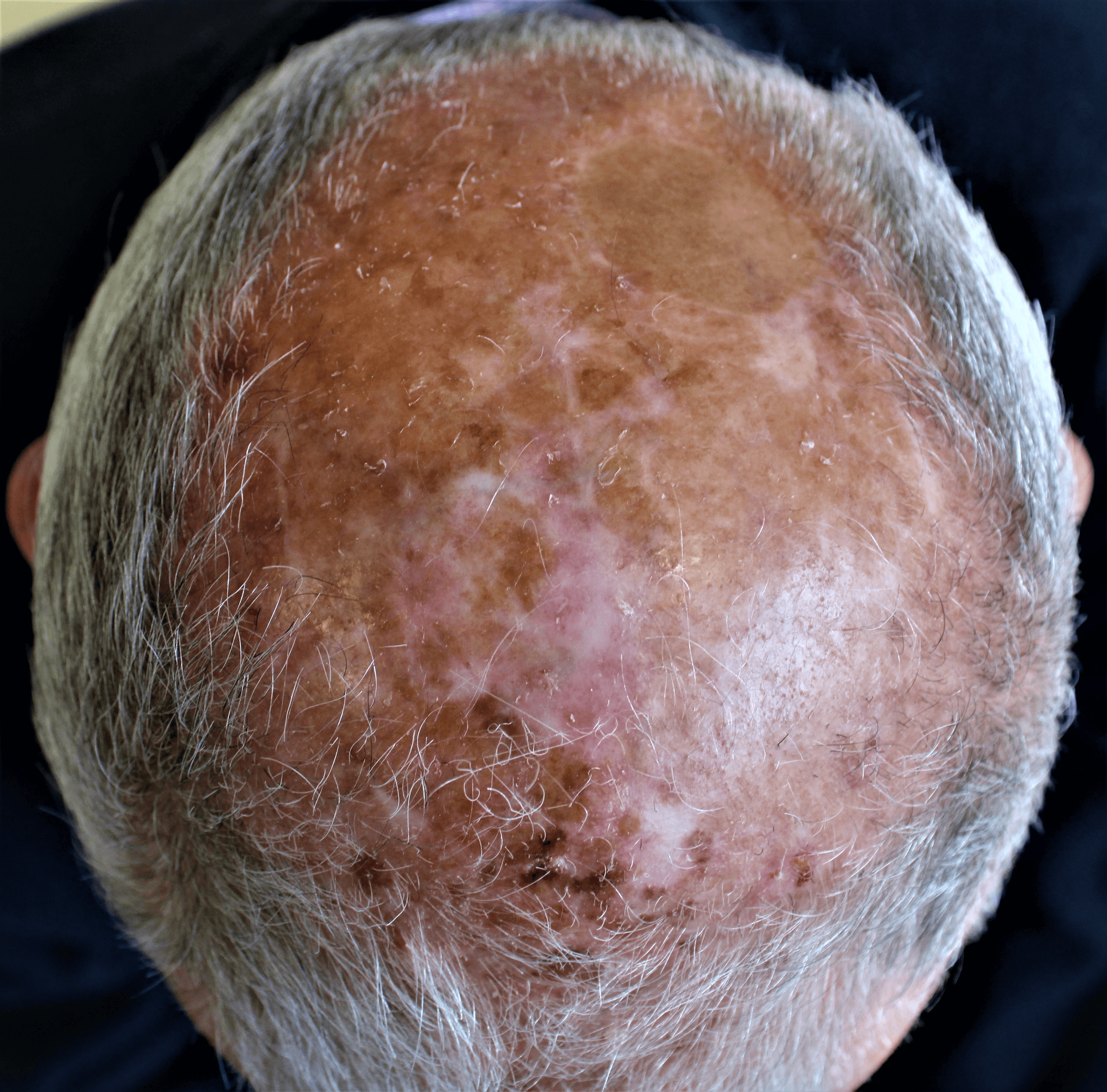 Actinic damage support programmes​