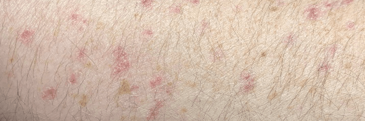 Disseminated Superficial Actinic Porokeratosis​