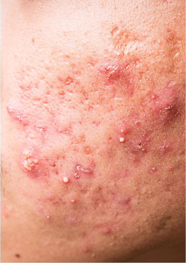 Acne and comedonal disease​