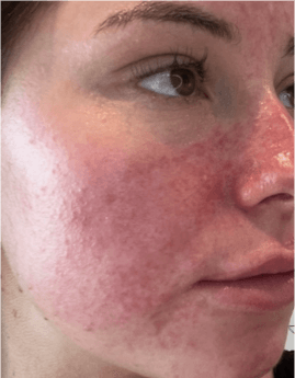 Rosacea​