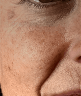 Photoageing and texture change​