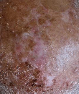 Actinic damage support programmes​