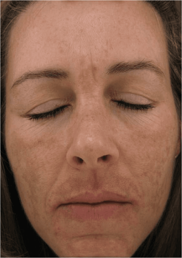 Melasma and dyschromia​