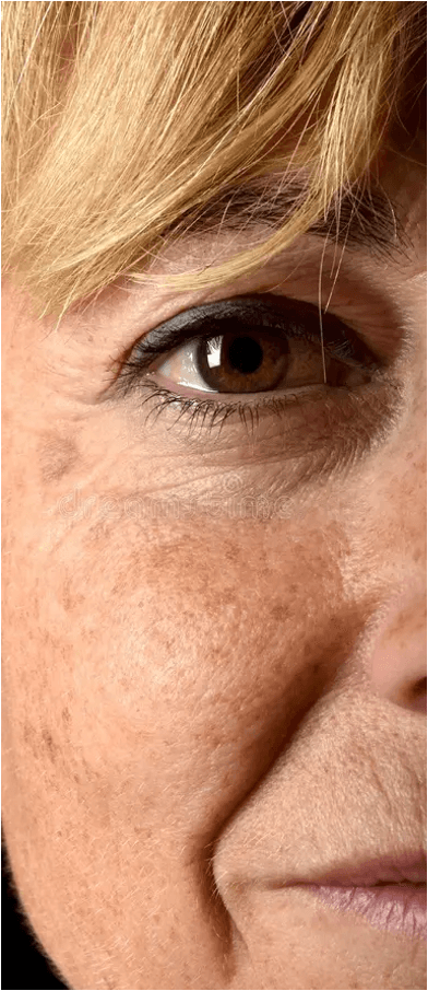 Photoageing and texture change​